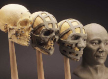 3d facial bone reconstruction