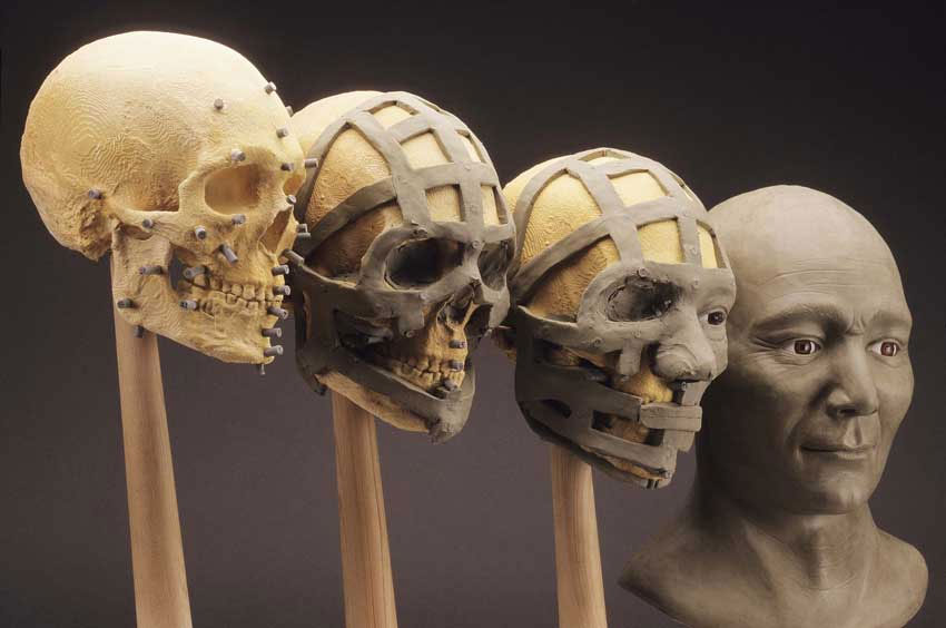 3d facial bone reconstruction